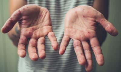 Salud descarta caso de sarampión en niña de dos años tras análisis de laboratorio